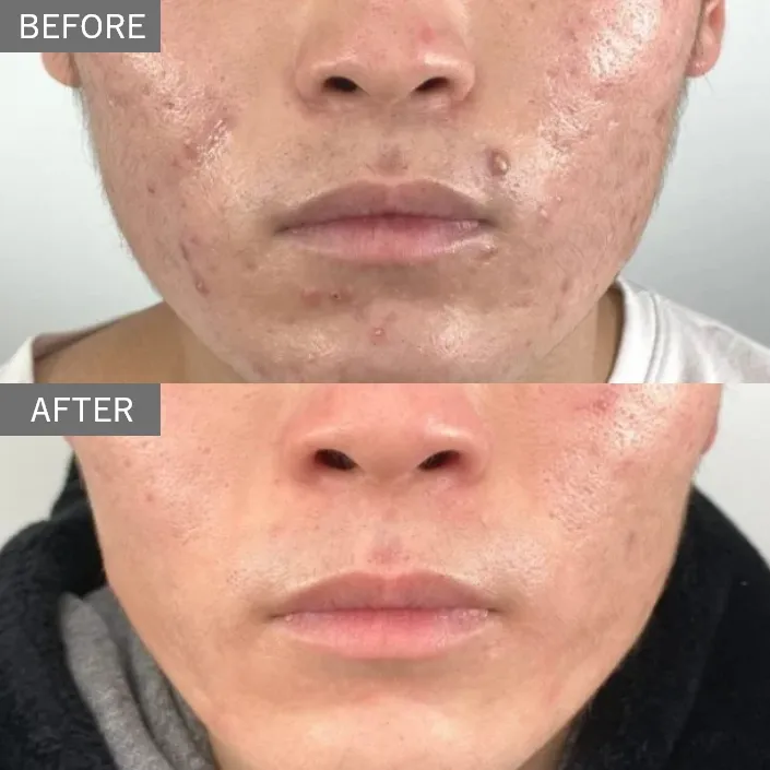 Oral Acne Medication