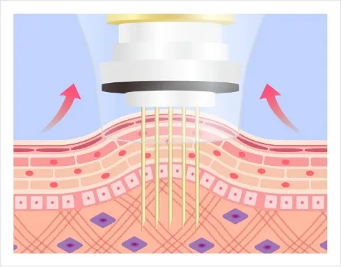 Therma Needle (FRM) Image
