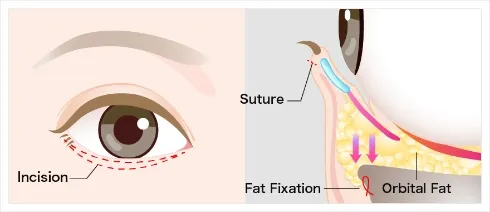 Treatment Process