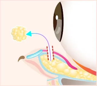Treatment Process