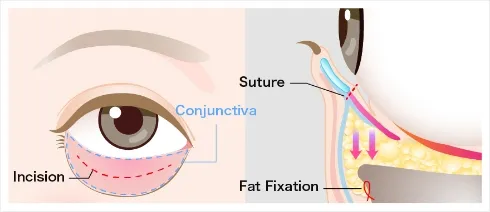 Treatment Process