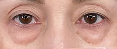 Non-Surgical Under-Eye Dark Circles and Puffiness Removal_before