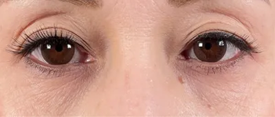 Non-Surgical Under-Eye Dark Circles and Puffiness Removal_after