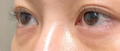 Non-Surgical Under-Eye Dark Circles and Puffiness Removal_before