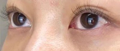 Non-Surgical Under-Eye Dark Circles and Puffiness Removal_after