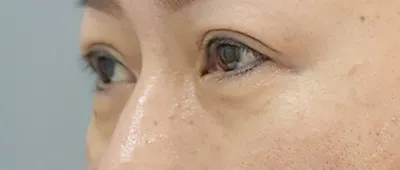 Lower Eyelid Surgery (Incisional Method)_before