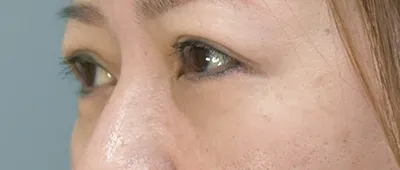 Lower Eyelid Surgery (Incisional Method)_after
