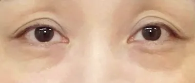 Lower Eyelid Surgery (Incisional Method)_before