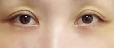 Lower Eyelid Surgery (Incisional Method)_after