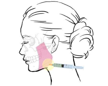 Masseter Botox Injection Image