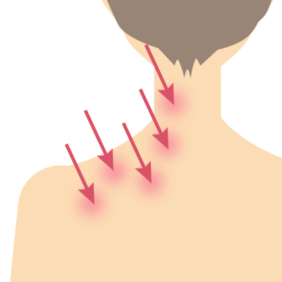 Shoulder Tension Botox Injection Image