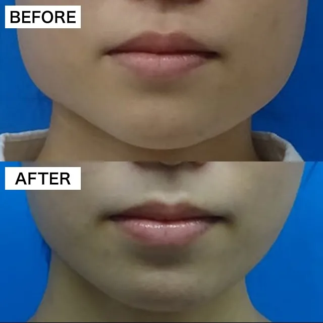 Before & After Photos