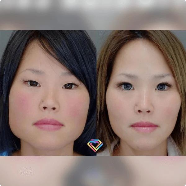 Before & After Photos