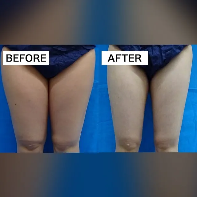 Fat-Dissolving Injection (BNLS Ultimate)