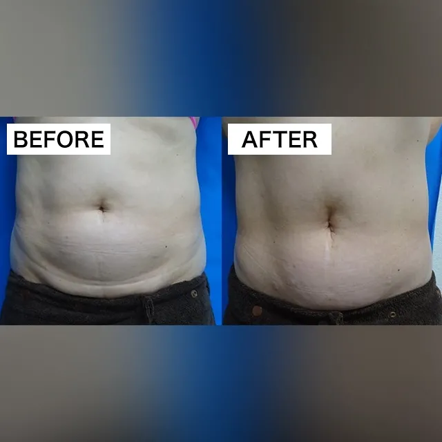 Fat-Dissolving Injection (BNLS Ultimate)
