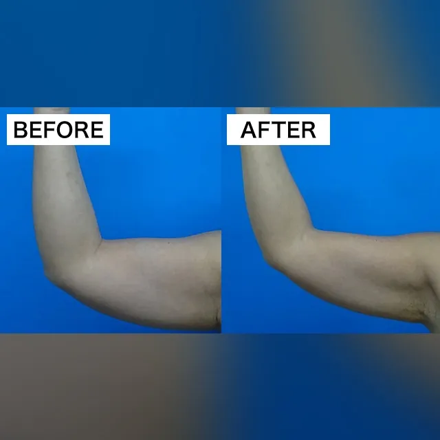 Fat-Dissolving Injection (BNLS Ultimate)