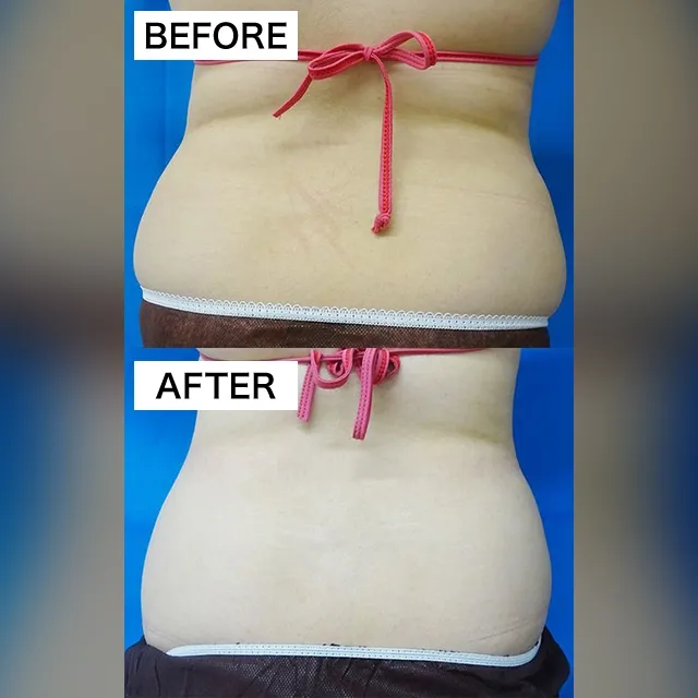 Fat-Dissolving Injection (BNLS Ultimate)