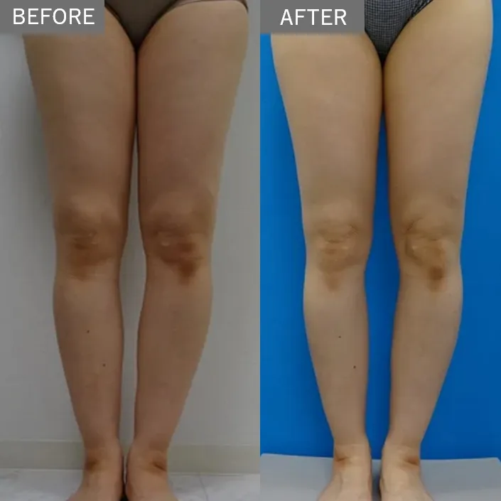 Mesoline Slim (Fat-Dissolving Injection)