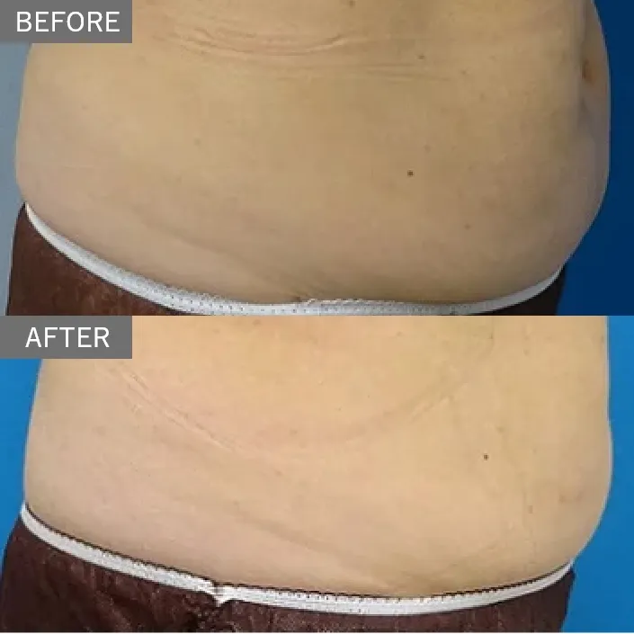 Mesoline Slim (Fat-Dissolving Injection)
