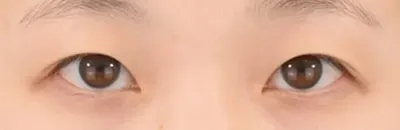 Upper Eyelid Fat Removal_before