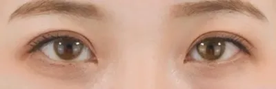 Upper Eyelid Fat Removal_after