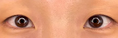 Upper Eyelid Fat Removal_before