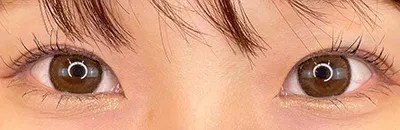 Upper Eyelid Fat Removal_after