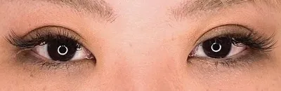 Double Incisional Eyelid Surgery_after