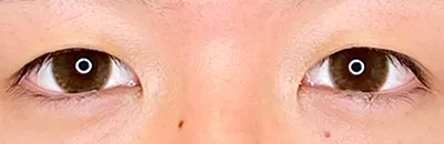 Double Incisional Eyelid Surgery_before