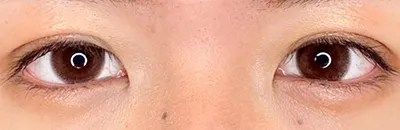 Double Incisional Eyelid Surgery_after