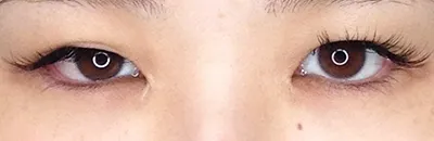 Levator Advancement 
(Quick Eye Enlargement Technique)_before