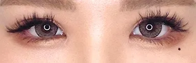 Levator Advancement 
(Quick Eye Enlargement Technique)_after