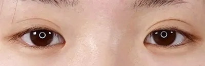 Medial Canthoplasty_before
