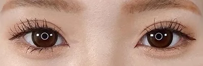 Medial Canthoplasty_after