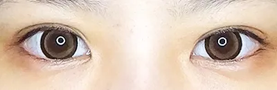 Medial Canthoplasty_before