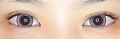Medial Canthoplasty_after