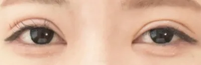Lateral Canthoplasty_before