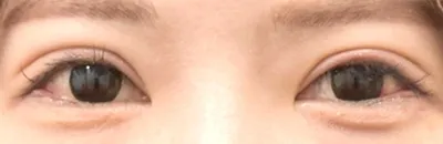 Lateral Canthoplasty_after