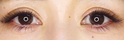 Lateral Canthoplasty_after