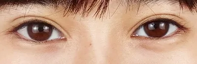Glamorous Line Surgery
(Downturned Eye Surgery)_before