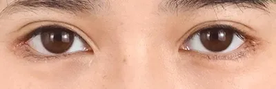 Glamorous Line Surgery
(Downturned Eye Surgery)_after