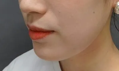 Medical HIFU (High-Intensity Focused Ultrasound)_after