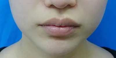 Masseter Botox (Facial Slimming Injection)_before