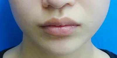 Masseter Botox (Facial Slimming Injection)_after