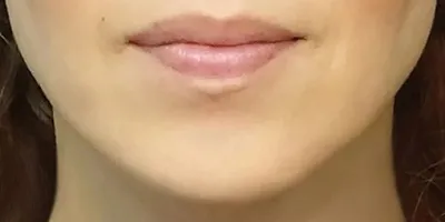 Masseter Botox (Facial Slimming Injection)_before