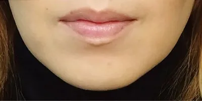 Masseter Botox (Facial Slimming Injection)_after