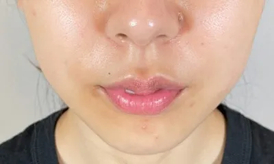 Buccal Fat Removal_after