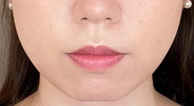 Buccal Fat Removal_before