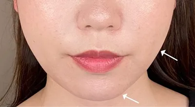 Buccal Fat Removal_after