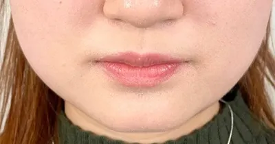Facial Liposuction_before
